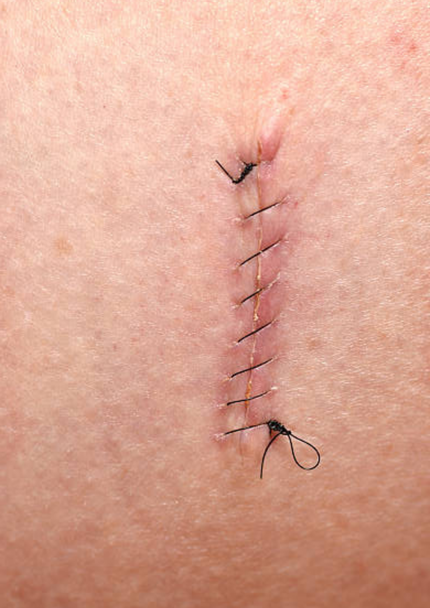 Heridas